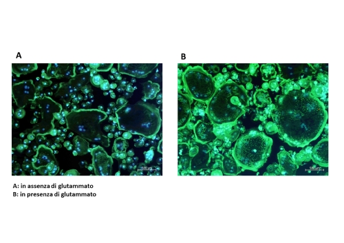Mieloma multiplo: il glutammato nel mirino per fer...